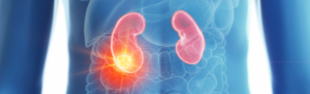 Bobby's Journey with Kidney Cancer