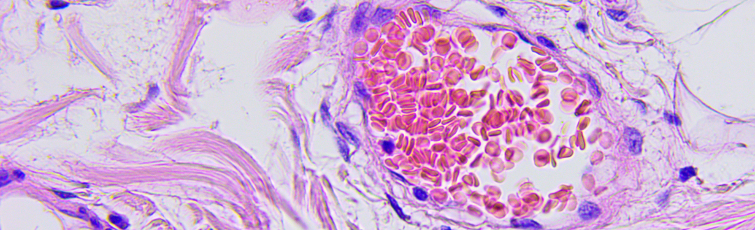 Astaxanthin / ValAsta Suppresses the Metastasis of Colon Cancer